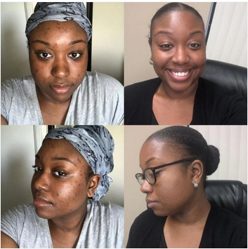 Anti-âge naturel, anti-taches puissant – la crème à l’acide kojique que votre visage attendait